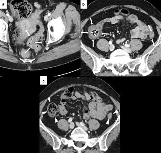 Imaging of diffuse immune-related colitis with a skipped distribution in a 49-year-old female with metastatic melanoma. After 4 months of treatment with Nivolumab (n = 12 cycles), patient presented with Grade 2 diarrhea and abdominal pain. CECT showed colonic wall thickening involving sigmoid (white arrows in A), descending and ascending colon (white arrows in B). Mucosal hyperenhancement was present in the ascending colon (white arrowheads in B). Nivolumab was discontinued until the resolution of the diarrhea and CECT after 4 months showed a normal colonic wall (white arrowheads in C).