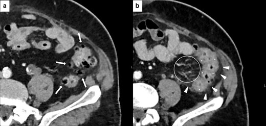 Imaging of SCAD of the descending-sigmoid colon in 76-year-old male with local and lymph nodal relapse of cutaneous angiosarcoma who presented lower abdominal pain and bloody diarrhea during nivolumab treatment. Axial CECT at baseline showed moderate wall thickening of the descending-sigmoid colon with underlying diverticulosis (white arrows in A). After 6 weeks of treatment, CECT showed a segmental wall thickening (white asterisks in B) with mesenteric vessel engorgement (area inside the white round in B) and pericolic fat stranding (white arrowheads in B).