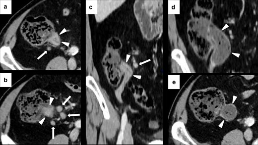 Imaging of terminal ileitis in a 80-year-old male with metastatic melanoma treated with nivolumab and history of inflammatory bowel disease (IBD). After 6 month of therapy, the patient presented abdominal distension and constipation. Axial CECT showed concentric wall thickening and mucosal hyperenhancement of the last ileal loop (white arrowheads in A, B and C) with some enlarged lymph node in the adjacent colonic fat (white arrows in A, B and C). Colonoscopy with biopsy was performed and histology showed a “terminal ileitis and intense chronic follicular inflammation associated with tiny ulcers, compatible with IBD”. Immunotherapy was not discontinued and the patient started a specific treatment for IBD. After 3 months, symptoms regressed and CECT showed a complete regression of the terminal ileitis (white arrows in D and E).