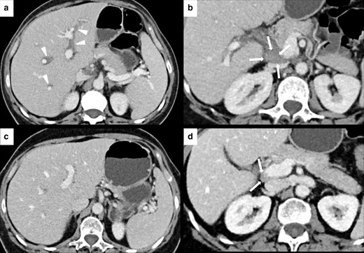 IRH in a 60-year-old female with renal cell carcinoma treated with nivolumab. After 3 months of therapy, the patient presented a slight elevation of gamma-glutamyltransferase (GGT) blood level and upper abdominal pain. Axial CECT showed periportal edema (white arrowheads in A) and new periportal enlarged lymph node (white arrows in B). CECT images after treatment discontinuation showed a complete resolution of the periportal edema (C) and the reduction of the periportal lymph node (white arrows in D).