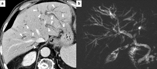 Imaging of immuno-mediated cholangitis in a 78-year-old male with metastatic melanoma, after 10 months of treatment with Atezolizumab. CT scan demonstrated bilateral intrahepatic bile duct dilatation (white arrowheads in A). Blood liver marker showed an increase of GGT, while transaminase levels were normal. MR cholangiopancreatography (B) confirmed CT findings and other causes of obstruction were not found. This pattern was classified as immuno-mediated cholangitis.