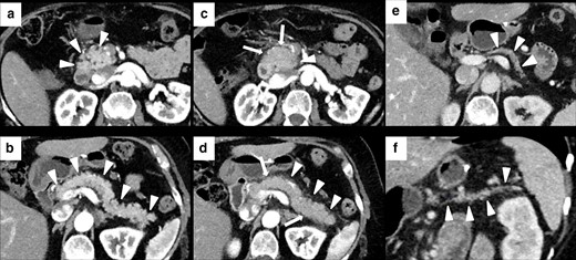 Imaging of ICIPI in a 61-year-old female with metastatic melanoma, treated with nivolumab. Baseline CECT showed normal appearance of the head (white arrowheads in A) and the body-tail (white arrowheads in B) of the pancreas. At follow-up after 4 months, patient presented dyspepsia, epigastric pain, diarrhea and elevation of lipase and amylase blood level. CT images showed a slight and homogeneous enlargement of the whole pancreas with loss of the physiologic lobulation (white arrows in C and D) associated with a subtle peripancreatic fat stranding (white arrowheads in C and D). This pattern was classified as IEP. ICI therapy was discontinued until normalization of blood lipase and amylase levels. Follow-up CT showed post-pancreatitis parenchymal atrophy (white arrowheads on axial and coronal CT, respectively, in E and F).