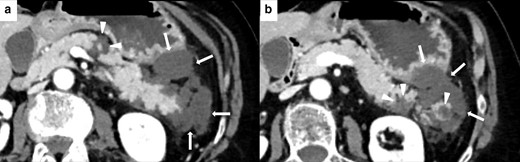 Imaging of NP in 62-year-old female during ICIs therapy for metastatic lung cancer. Axial CECT shows three necrotic unenhancing, slightly inhomogeneous, hypodense focal areas in the body and tail of the pancreas (white arrowheads in A and B), with necrosis of the peripancreatic fat planes (white arrows in A and B).