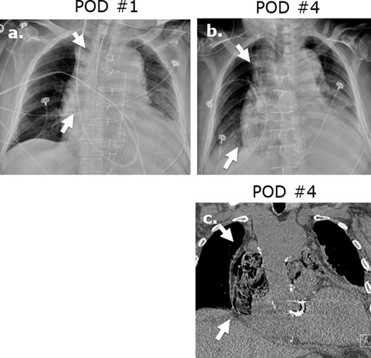 Surgicel mimicking mediastinitis following cardiothoracic surgery. Portable AP chest radiographs were obtained at post-operative day 1 (a) and post-operative day 2 (b) revealing increasing lucencies in the mediastinum in this 83-year-old male status post-mitral valve and hemiarch aortic repair. Coronal (c) image on unenhanced CT performed at post-operative day ® reveals a gas-containing collection in the mediastinum with appearance typical of Surgicel. Correlation with the surgical report confirmed retained Surgicel for post-operative hemostasis.