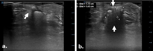 Surgicel in the subcutaneous tissue mimicking a gas containing collection on ultrasound. Focused ultrasound exam images (a, b) were used to evaluate the surgical cut down site following angioplasty in a 75-year-old male. Images depict a focal echogenic mass-like area with posterior acoustic shadowing in keeping with the known Surgicel that was retained post-operatively for hemostasis. This appearance closely mimics an air containing collection.