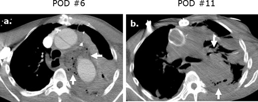 Surgicel mimicking mediastinitis following cardiothoracic surgery on CT. Axial (a) intravenous contrast-enhanced CT following repair of a type A aortic dissection in a patient with leukocytosis at post-operative day ® and demonstrates a large gas-containing collection. Correlation with the surgical note confirmed that Surgicel was retained post-operatively for hemostasis. A follow-up axial unenhanced CT (b) obtained at post-operative day 11 demonstrates interval partial resorption of the Surgicel.