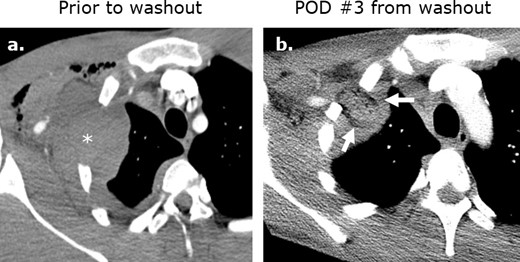 Surgicel mimicking abscess formation following washout of an iatrogenic hematoma. (a) Axial intravenous-enhanced CT image obtained at post-operative day 9 following ®st rib resection for thoracic outlet syndrome in a 19-year-old male with pain and tachycardia revealing a hematoma at the surgical site. Axial (b) and coronal (c) intravenous contrast-enhanced images obtained following washout of the hematoma reveals Surgicel in the operative bed.