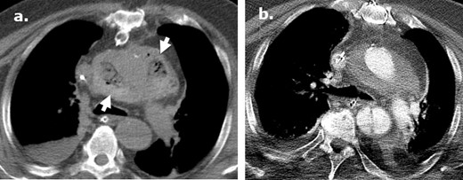 Longitudinal postoperative changes of Surgicel following type A aortic dissection repair. An axial image from an unenhanced CT (a) performed in a 71-year-old male at post-operative day ® following a type A dissection repair demonstrates a heterogeneous gas-containing collection surrounding the aortic root in keeping with Surgicel. Subsequent axial intravenous-enhanced CT (b) performed at post-operative day 11 reveals near resolution of the Surgicel with evolution to a homogenous perigraft collection typically seen in the post-operative setting.