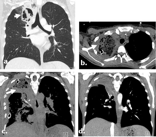 Surgicel in the post-operative bed mimicking infection following a lobectomy on CT. A 37-year-old female with AML and aspergilloma. Surgicel was used intraoperatively for hemostasis. Coronal (a) unenhanced CT images demonstrate an aspergilloma in the right upper lobe of the lung. Axial and coronal (b., (c) unenhanced CT images obtained 4 days post-surgery demonstrate large surgical cavity filled with low attenuation material mimicking a gas-containing infectious collection which was confirmed to be Surgicel on the operational note. Coronal (d) unenhanced CT images obtained 2 months after surgery demonstrate resolution of the finding.