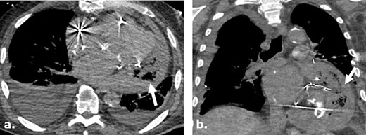 Surgicel mimicking infected pericardial fluid following cardiothoracic surgery complicated by sepsis and shock. Axial (a) and coronal (b) non-contrast-enhanced CT images of a 75-year-old male following pericardial washout and irrigation of an infected pericardial effusion demonstrates large complex gas-containing pericardial effusion, mimicking infected collection. Surgical note indicates intraoperative utilization of Surgicel for hemostasis.