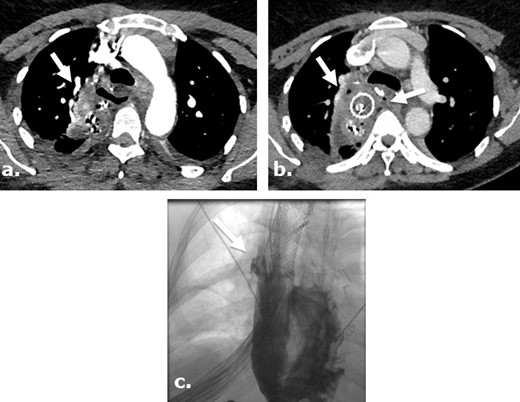 Anastomotic leak after Ivor Lewis esophagogastrectomy in a surgical case where Surgicel was not used. Axial images of a contrast-enhanced CT obtained 5 days after surgery (a) in a 46-year-old female with a history of stage I esophageal adenocarcinoma, demonstrates extra luminal gas anterior to the enteric tube. An axial view of contrast-enhanced CT obtained 9 days after surgery (b) demonstrates persistent gas and fluid surrounding the now stented gastric pull through. Single upper gastrointestinal series with water-soluble contrast obtained 13 days after surgery (c) demonstrates persistent leak at the level of esophagogastric anastomosis.
