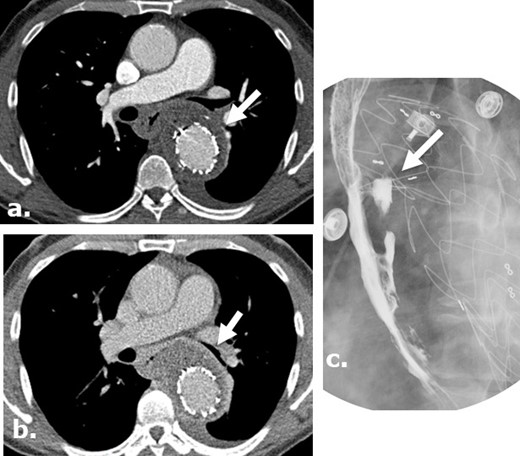 Aorto-esophageal fistula, leading to mediastinal abscess in a surgical case where Surgicel was not used. Arterial (a) and delayed (b) phases of CTA of the chest of a 56-year-old male demonstrate perigraft gas-containing fluid collection containing small gas bubbles. There is esophageal wall thickening and loss of the fat plane between the aorta and esophagus. A barium swallow study demonstrates extravasation of barium toward the aortic stent, consistent with aorto-esophageal fistula (c).). Patient was treated with antibiotics and G-tube placement.