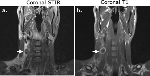 Subcutaneous Surgicel collection following stab wound injury and superficial dissection on MRI. Coronal STIR (a) and coronal T1-weighed (b).) images of the neck in a 29-year-old male following a stab wound injury with Surgicel retained at the surgical site to promote hemostasis. The Surgicel material is nearly uniformly low in T 2-weighted signal intensity relative to fluid (a) and demonstrates a rim of high signal intensity relative to muscle on unenhanced T 1-weighted imaging (b).