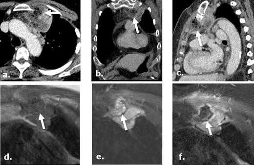 A 75-year-old female post-biopsy of a mediastinal mass. Contrast-enhanced CT images axial (a), coronal (b) and sagittal (c), day 7 post-biopsy, demonstrate heterogeneous, complex gas-containing collection medial to a biopsied mass, referring physician has confirmed the use of Surgicel during the procedure in this location. MRI images of the same region obtained status post biopsy day 12 demonstrate a collection isointense to muscle on coronal unenhanced T1 (d) and heterogeneous intensity focus on coronal STIR (e) with no enhancement in the retained Surgicel on coronal gadolinium enhanced T1-weighed (f). There are punctuate low intensity foci in the collection compatible with gas while surrounding chest wall and mass demonstrate enhancement.
