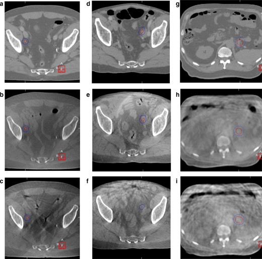 Planning CT and CBCT images with/without IM and i.v. buscopan for three patients. GTV and PTV are shown in each image. CBCT, cone beam CT; GTV, gross tumour volume; PTV, planning target volume.