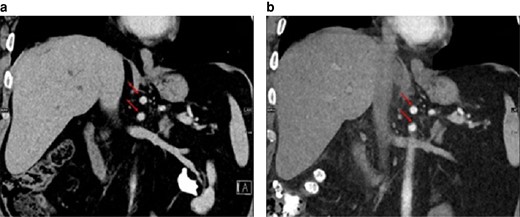 No change in position of the coeliac trunk and superior mesenteric artery (arrows) in-between the preoperative image and the postoperative image (15 days after left-sided hemihepatectomy)