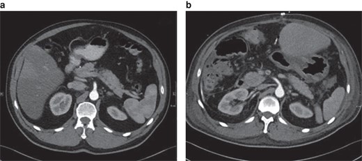 Class I position change of the superior mesenteric artery in-between the preoperative image and the postoperative scan (11 days after right-sided hemihepatectomy)