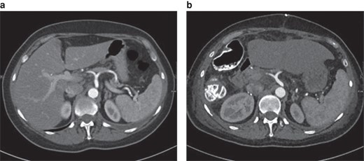 Class I position change of the coeliac trunk in-between the preoperative image and the postoperative scan (12 days after right-sided hemihepatectomy)