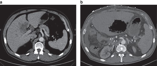 Class II position change of the coeliac trunk in-between the preoperative scan and the postoperative scan (32 days after right-sided hemihepatectomy)