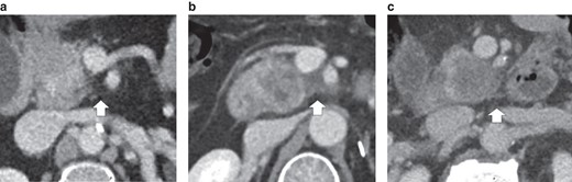 Characterization of mesopancreas infiltration according to contrast-enhanced CT