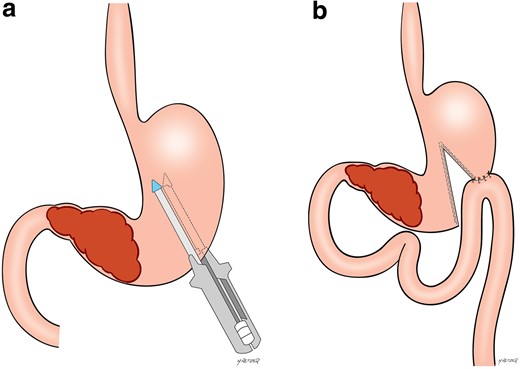 Gastric partitioning surgical scheme