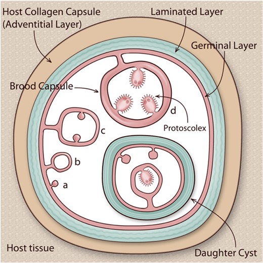 Structure of the hydatid cyst. E. granulosus sensu lato larvae (hydatids) are a bladder-like structures lodged in intermediate hosts’ organ parenchymas. Each hydatid is bounded by a hydatid wall, comprising an inner cellular germinal layer and an outer acellular laminated layer. The hydatid is usually surrounded by a host-derived collagen capsule, but can also be encircled by host inflammatory cells, plus varying amounts of fibrous tissue; the area of host reaction, especially when it is fibrous, is called adventitial layer. The hydatid and the local host reaction together form the hydatid cyst. The hydatid is filled with hydatid fluid (hydatid cyst fluid; depicted in white in the figure). After a lapse of months or years, the germinal layer may bud towards the inside, giving rise to brood capsules, which in turn bud towards their inside to generate protoscoleces (phases a–d in the figure). Upon ingestion by a dog or another canid, protoscoleces establish in the intestine, growing into adults that release eggs, in turn capable of giving rise to hydatids if ingested by appropriate hosts. However, protoscoleces are also capable of reserve development into hydatids if released into tissue by cyst rupture. Daughter hydatids (‘daughter cysts’), with their own complete hydatid wall, occasionally form within larger hydatids. Adapted from references7 and 45, with permission.