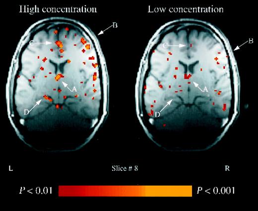 Thalamic activation. Example of slice 8 in a single subject. An increase in activation associated with the high concentration condition is evident in the: thalamus (A); inferior frontal gyrus (B); cingulate gyrus (C) and hippocampus (D).