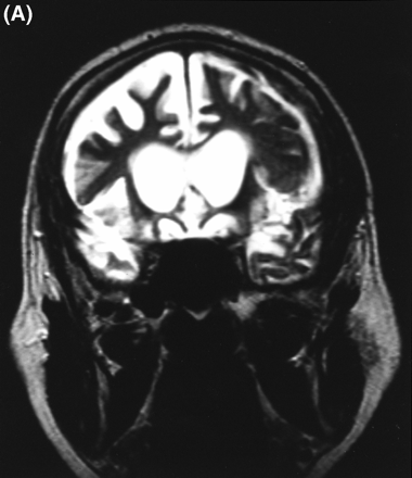 (A) T2-weighted MRI scan of subject III-4 from Family D at age 56 years, showing marked frontal atrophy, the right sidebeing worse than the left. (B) MRI scan of subject III-8 from Family F at age 61 years, showing severe bilateral temporal atrophy.(C) Technetium-99 (25.8 mCi) perfusion scan performed on subject III-24 in Family F at age 63 years. Decreased perfusion bilaterally in the frontal regions and in the right temporal region is demonstrated.