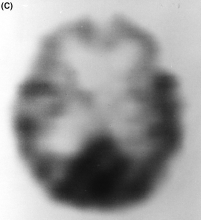 (A) T2-weighted MRI scan of subject III-4 from Family D at age 56 years, showing marked frontal atrophy, the right sidebeing worse than the left. (B) MRI scan of subject III-8 from Family F at age 61 years, showing severe bilateral temporal atrophy.(C) Technetium-99 (25.8 mCi) perfusion scan performed on subject III-24 in Family F at age 63 years. Decreased perfusion bilaterally in the frontal regions and in the right temporal region is demonstrated.
