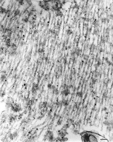 Electron micrograph of neuronal neurofibrillary tangles from parahippocampus of subject II-4 of Family D, showing twisted filaments with a periodicity of ~110 nm and a diameter of ~32 nm. Straight filaments were also seen. Bar = 200 nm.
