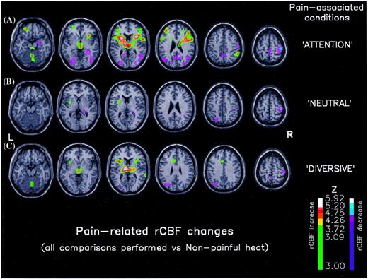 Variations of pain-related rCBF according to the attentional context. Each of the three conditions using noxious stimuli (P, 1, 3 and 5) was succesively compared with the reference condition [2, non-painful heat (p), no task]. The context associated with the noxious stimuli conditions was: (A) attention to the stimulus, (B) no task, and (C) attention away from the stimulus (diversive). The only region of rCBF increase common to the three comparisons was the insula/SII response contralateral to pain (conjunction analysis, P ≤ 0.0001, corrected). The bilateral rCBF increase in thalamus (A and C) was seen in both attentional conditions and may be considered as a marker of non-specific attention or arousal. When attention was focused to the stimulated hand (A) rCBF changes in prefrontal and posterior parietal cortices were disclosed, with a localization similar to the selective attentional network (Fig. 2; Table 1). The size and the significance of decreased rCBF in SI ipsilaterally to stimulation (conjunction analysis, P = 0.001, corrected) increased with the level of attention to pain and was assumed to reflect anticipation. Auditory attention (diversive from pain) showed rCBF increase in the temporal neocortex, immediately posterior to Heschl's gyrus (C). Increased rCBF in the anterior cingulate gyrus was observed when the subject's attention was directed away from pain (C) suggesting an alerting effect, orienting to pain or attentional shift. In each omparison, data were thresholded for Z > 3.09 and P corrected for cluster size and Z score was P < 0.05.