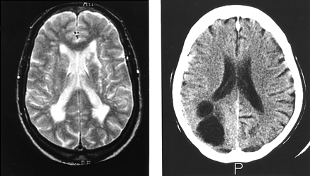  Structural imaging of Subjects 2 and 6. MRI of Subject 2 (left) shows multiple vascular lesions in the hemispheric deep white matter. CT scan of Subject 6 (right) shows a large arachnoid cyst in the right occipital lobe.