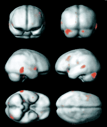  Functional imaging (correlated activity with hallucination strength surface reading). PET group analysis for Subjects 1–4 showing areas where regional cerebral blood flow increased as a linear function of hallucinosis intensity. The functional data shown were thresholded at the P < 0.001 (uncorrected) voxel level and rendered on to an MRI surface template with the same degree of smoothing as the PET data.