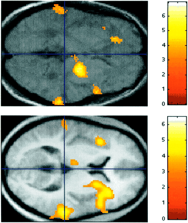  Functional imaging. (Top) PET group analysis for Subjects 1–4 showing areas where regional cerebral blood flow increased as a linear function of hallucinosis intensity (no sound stimulus). The data shown were rendered on to an axial section of the mean T1-weighted MRI for the four subjects. (Bottom) For comparison, data for the activation during the normal perception of patterned–segmented sound in nine normal subjects (Griffiths et al., 1999a) are shown superimposed on an axial section at the same level. Both sections are at the vertical level z = 0 mm. A line at y = –30 mm corresponds to the anteroposterior maximum for the planum temporale (Westbury et al., 1999). Notice the bilateral activation in the region of the planum temporale in both analyses.