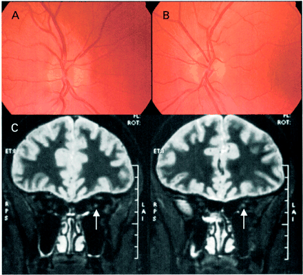 Acute fundal appearance (A, right; B, left) and T2-weighted coronal MRI images (C) of III-2 from the British LHON family. The arrow indicates the high-signal region in the left optic nerve.