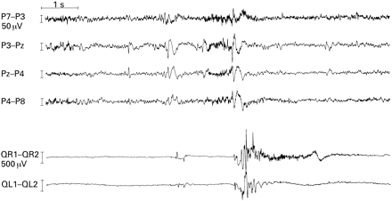 Single spikes causing clinical (myoclonic) seizures. Ten seconds of EEG of a patient with a left parietal focal cortical dysplasia and left parietal lobe epilepsy is shown. Repetitive spikes with a maximum at Pz were recorded. Small spikes (first second) are not followed by any motor phenomenon. With increasing amplitude (second and third seconds), the spikes are associated with bilateral asymmetrical (right > left) myoclonic seizures of increasing strength and duration. Recording parameters: International 10-10 system, transverse bipolar montage with surface EMG recording from the right (QR1–QR2) and left quadriceps femoris muscles (QL1–QL2).