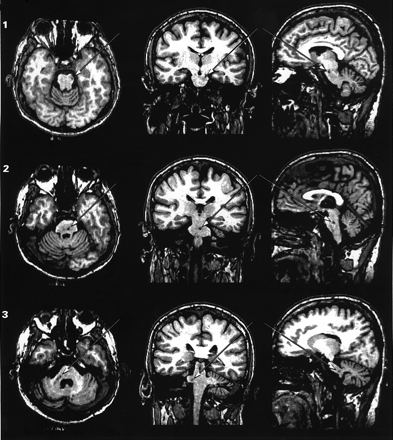 Lesions in patient C.B. The MRIs show the neuroanatomical correlates of the lesions of Patient C.B. in the axial (first column), coronal (second column) and parasagittal planes (third column). In total, five small lesions were detected: first lesion (1) was 2 × 1 × 1 mm in size at the pontomesencephalic junction, affecting the left cerebral peduncle in its lateral segment where descending tracts from the occipital, parietal and temporal cortices travel (Martin, 1996; Afifi and Bergman, 1998) (see Fig. 3). The second lesion (2) was 4 × 3 × 3 mm in size in the midline basis pontis and at the level of mid-to-upper pons. This region contains pontine nuclei of the left and the crossing fibres from the pontine nuclei of the right basis pontis. This region of the basis pontis receives input principally from the prefrontal cortex (Schmahmann and Pandya, 1997a) and the anterior cingulate gyrus (Vilensky and Van Hoesen, 1981). The third and fourth lesions (3 and 4) are almost continuous (i.e. 3–4 mm apart), both affecting the middle cerebellar peduncles from its brainstem root until the white matter below the superior semilunar lobule. These two lesions were together 12 mm in axial plane and varied from 2 to 5 mm in coronal and parasagittal planes. Finally, the fifth lesion (5) was 6 × 2 × 2 mm in size affecting, also on the right cerebellum, the white matter of the inferior semilunar lobule. In summary, all five lesions disrupt the topographically organized input from the higher association areas to the cerebellum. MRIs were taken 14 months and 4 days after C.B.'s stroke.