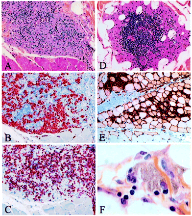 Deltoid muscle biopsy of patients with macrophagic myofasciitis (light microscopy): (A) tightly packed macrophages intermingled with lymphocytes in epimysium (haematoxylin and eosin, ×100); (B) adjacent section of the same biopsy showing immunolocalization of the macrophage marker CD68 (alkaline phosphatase–anti-alkaline phosphatase, APAAP, ×100); (C) adjacent section of the same biopsy showing immunolocalization of the T-cell marker CD3 (APAAP, ×100); (D) nodular aggregation of lymphocytes with microvascular neoangiogenesis, consistent with a primary lymphoid follicle developed in the centre of an epimysial islet of macrophages (haematoxylin and eosin, ×100); (E) HLA class I antigen expression in both macrophages accumulated in endomysium and adjacent muscle fibres (peroxidase–anti-peroxidase, PAP, ×70); and (F) lymphocytes stuck to a granular macrophage (haematoxylin and eosin, ×600).