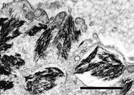 Deltoid muscle biopsy of patients with macrophagic myofasciitis (electron microscopy): (A) an endomysial macrophage filled with dense osmiophilic intracytoplasmic inclusions (bar = 10 μm); (B) at higher magnification inclusions are frequently membrane-bound and show a finely spicular structure (bar = 0.5 μm).