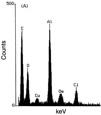 Microanalytic studies. (A) X-ray microanalysis: low energetic X-ray spectra obtained using energy dispersion spectrometer of intracytoplasmic inclusions of macrophages showing a peak specific of aluminium (Al) and peaks due to copper (Cu), osmium (Os) and chloride (Cl) that constitute the background. (B) Nuclear microanalysis: particle induced X-ray emission microanalysis showing an abnormal presence of aluminium in muscle tissue strictly restricted to the areas of macrophage infiltrates: aluminium level was 53 310 ± 9600 μg/g in macrophages and 105 ± 20 μg/g in the centre of the muscle fibre. A spatial correlation is observed on the elemental maps for aluminium and phosphorus.