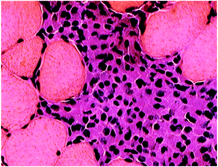Intramuscular injection site of HBV vaccine in a Sprague–Dawley rat at Day 21 post-injection: tightly packed basophilic macrophages infiltrated between muscle fibres (haematoxylin and eosin, ×250).