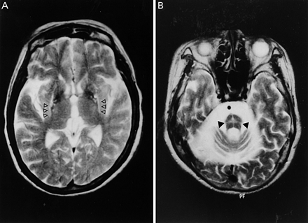 Fig. 1 MRI signal abnormalities in patients with multiple system ...