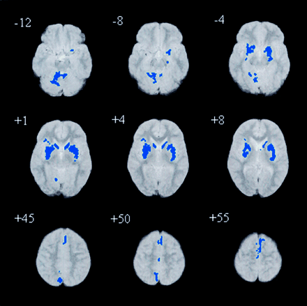 Fig. 2 Relative deficits clusters (blue) in grey matter volume in people with Asperger’s syndrome compared with controls. The maps are orientated with the right side of the brain shown on the left side of each panel. The z coordinate for each axial slice in the standard space of Talairach and Tournoux is given in millimetres.