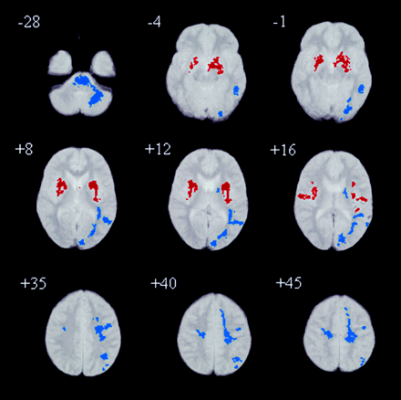 Fig. 3 Relative deficits clusters (blue) and excesses clusters (red) in white matter volume in people with Asperger’s syndrome compared with controls. The maps are orientated with the right side of the brain shown on the left side of each panel. The z coordinate for each axial slice in the standard space of Talairach and Tournoux is given in millimetres.