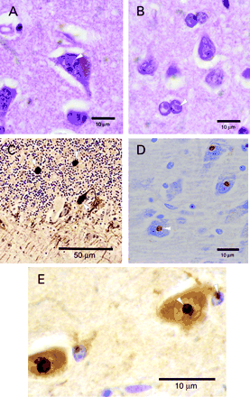 Fig. 2 (A and B) Typical intranuclear inclusions observed in neurones and astroglia, respectively, of Case 1 (H&E stain, original magnification 1000×). (C) Scattered axonal torpedoes in cerebellum, labelled with anti‐neurofilament antibody (original magnification 400×). (D and E) Intranuclear inclusions stained with anti‐ubiquitin antibodies (original magnification 1000×); Cases 2 and 1, respectively. We found non‐specific variability in neuronal cytoplasmic staining by anti‐ubiquitin antibody within individual cases as well as between cases. This variability could have pathological significance, but could also have a methodological and/or technical component.
