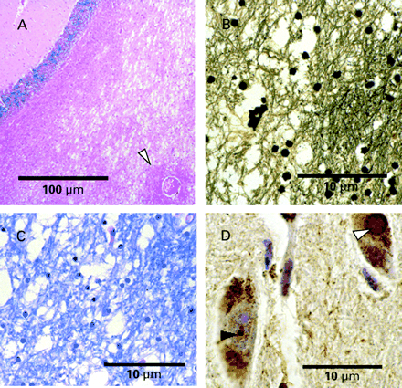 Fig. 4 (A) Marked spongiosis of deep cerebellar white matter is seen in Case 2. The arrowhead indicates relatively normal perivascular white matter (H&E stain, original magnification 100×). (B) Silver stain identifying axonal loss in areas of white matter vacuolation (Bielschowsky stain, original magnification 400×). (C) Myelin stain demonstrating irregular vacuolation and loss of myelin (LFB‐PAS stain, original magnification 400×). (D) Anti‐ubiquitin staining of Case 4 demonstrates both an intracytoplasmic Lewy body (white arrowhead) and an intranuclear inclusion (black arrowhead) within pigmented neurones of the substantia nigra (original magnification 1000×).