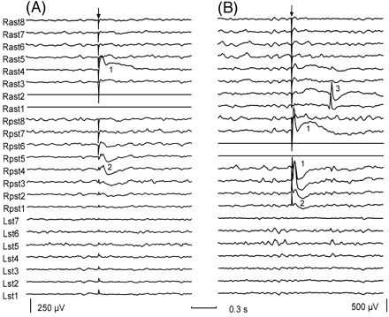 Fig. 1 Early and delayed responses evoked by single pulse electrical stimulation. The patient showed focal seizures starting at electrode 1 of the right anterior subtemporal strip (Rast1). (A) Early responses seen when stimulating the deepest electrodes of the right anterior subtemporal region (Rast1, Rast2, shown as flat traces). (B) Early and delayed responses during stimulation through electrodes located at the right posterior subtemporal region (Rpst4, Rpst5). Numbers inserted in the figure indicate different response types: (1) early responses seen at electrodes located close to the stimulating electrodes; (2) early responses seen at electrodes located >3 cm away from the stimulating electrodes; and (3) delayed responses seen with a latency of >100 ms. The arrows indicate the stimulation artefact. Both recordings have similar time calibration but different gain. For each subdural strip, electrode 1 was the most distal electrode to the insertion burr hole. Abbreviations: Lst = left subtemporal strip; Rast = right anterior subtemporal strip; Rpst = right posterior subtemporal strip. 