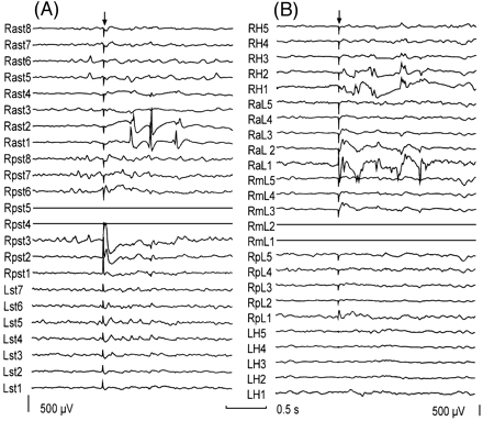 Fig. 2 Bursts of delayed responses evoked by a single stimulus. (A) Burst of delayed responses seen at Rast1 and Rast2 during stimulation through Rpst4 and Rpst5 in the same patient as in Fig. 1. (B) Bursts of delayed responses recorded by depth electrodes located in the hippocampus (RaL1, 2 and RH1, 2) in a different patient with a lesion located at the lateral convexity of the temporal lobe. The arrow indicates the stimulation artefact. Both recordings have the same time calibration but different gain. For each subdural strip or depth electrode bundle, the most distal electrode to the insertion burr hole was electrode 1. In B, contacts 1 and 2 of each depth electrode bundle are located at mesial temporal structures. Electrodes used for stimulation are shown as flat traces. Abbreviations: LH = left hippocampus electrode; Lst = left subtemporal strip; RaL = right electrode anterior to the lesion; Rast = right anterior subtemporal; RH = right hippocampus electrode; RmL = right electrode medial to the lesion; RpL = right electrode posterior to the lesion; Rpst = right posterior subtemporal strip. 