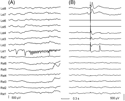 Fig. 3 Relation between focal seizure onset and focal delayed responses. (A) A subdural recording of a focal seizure onset. Note the fast activity building up in the electrode 1 of the left subtemporal region (Lst1). (B) Delayed response seen at Lst1 during stimulation through electrodes 6 and 5 of the left subtemporal strip (Lst5, Lst6). There are also sharp early responses observed at Lst8, Lst7, Lst4, Lst3, with maximal amplitude at Lst8. Note that seizure onset occurs at the site where delayed responses were seen rather than at the site of stimulation which, in this case, is located 4 cm away. The arrow indicates the stimulation artefact. Both recordings have the same time calibration but different gain. For each subdural strip, electrode 1 was the most distal electrode to the insertion burr hole. Electrodes used for stimulation are shown as flat traces. Abbreviations: Lst = left subtemporal strip; Rst = right subtemporal strip.