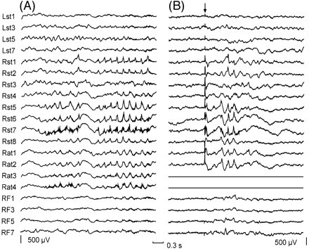 Fig. 4 Relation between regional seizure onset and regional delayed responses. (A) A subdural recording of a regional seizure onset. Note that most electrodes of the right subtemporal region and all electrodes of the right anterior temporal strip are involved. (B) Delayed responses seen at the same location during stimulation through electrodes 3 and 4 of the right anterior temporal strip (Rat3, Rat4). The arrow indicates the stimulation artefact. Both recordings have the same time and amplitude calibrations. For each subdural strip, electrode 1 was the most distal electrode to the insertion burr hole. Electrodes used for stimulation are shown as flat traces. Abbreviations: Lst = left subtemporal strip; Rat = right anterior temporal strip; Rst = right subtemporal strip.